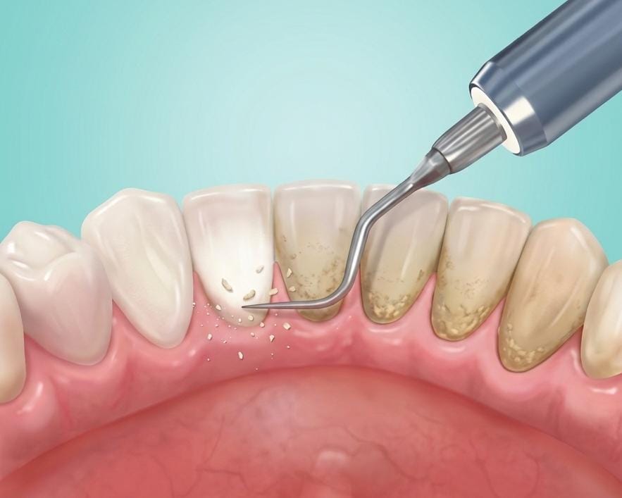 Periodontia em Contagem MG